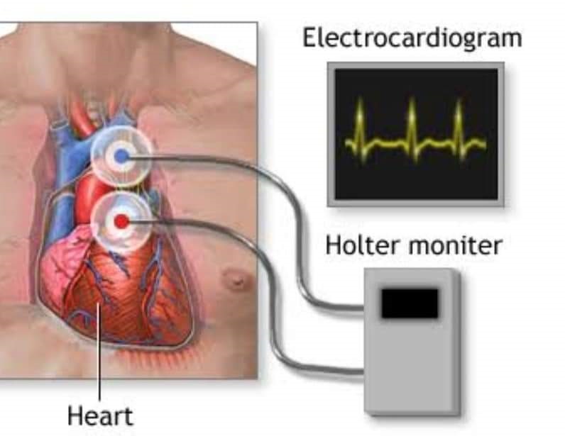 ಹೃದಯದ ಜಾತಕ ಜಾಲಾಡುವ ಹೋಲ್ಟರ್ ಮಾನಿಟರ್… ಏನಿದು ಇಲ್ಲಿದೇ ಸಮಗ್ರ ಮಾಹಿತಿ